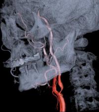 Stenóza krkavice na angiografii