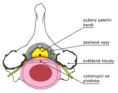 Schéma obratle - stenóza páteřního kanálu